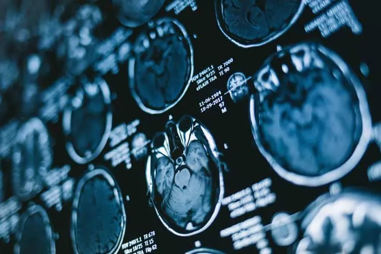 Een reeks MRI-beelden van hersenen